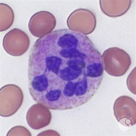 Hypersegmented Neutrophil
