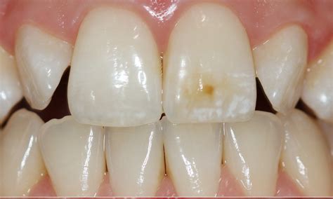 Hypomineralization How To Get Rid Of White Spots On Teeth Fluorose