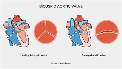 Implications Of Bicuspid Aortic Valve Disease And Aortic Stenosis