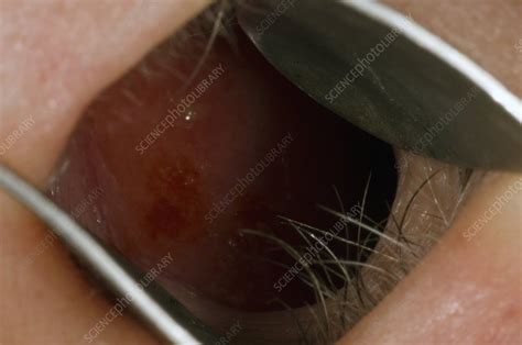 Inflamed Mucosa In The Nose Stock Image C004 4237 Science Photo