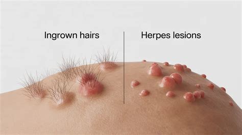 Ingrown Hair Vs Herpes