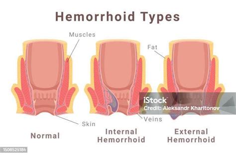 Internal Vs External Hemorrhoid