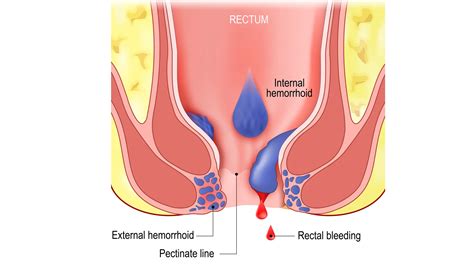 Internal Vs External Hemorrhoids Recognizing The Differences And