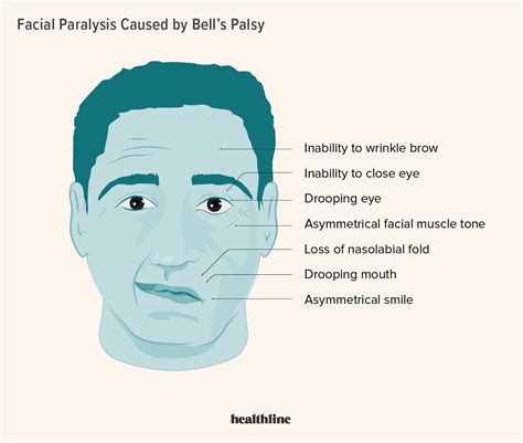 Is Bell's Palsy Contagious