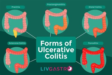 Is Colitis Contagious
