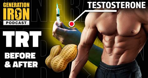 Is Trt Steroids
