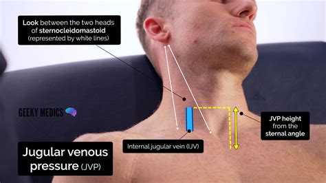 Jugular Venous Pulse Distention Definition Causes Location