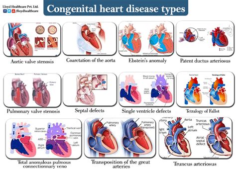 Keyword For What Are The 5 Main Types Of Congenital Heart Disease