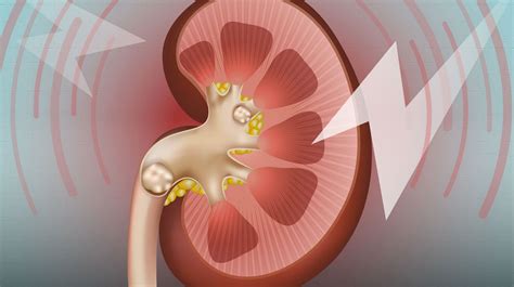 Kidney Stones A Marker Of Overall Kidney Health Uab News