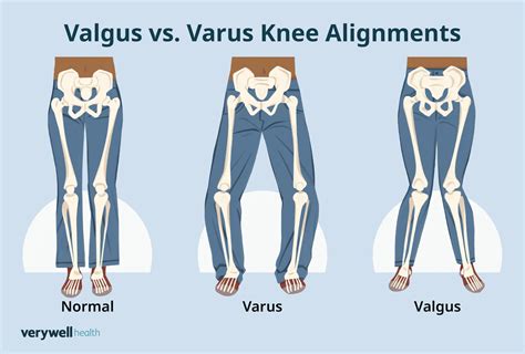 Knee Valgus Vs Varus