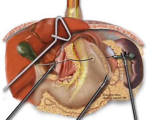 Laparoscopic Paraesophageal Hiatus Hernia Repair Operative Techniques