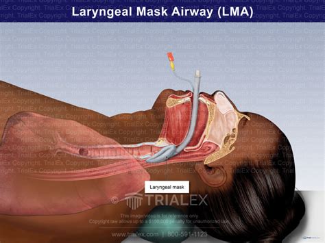 Laryngeal Mask Airway Lma