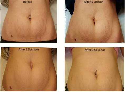 Laser Stretch Mark Removal Doctor S Review Before After