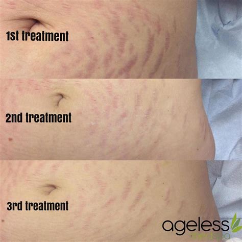 Laser Stretch Mark Removal