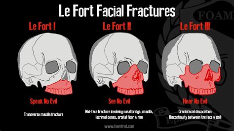 Le Fort Fracture Treatment Options
