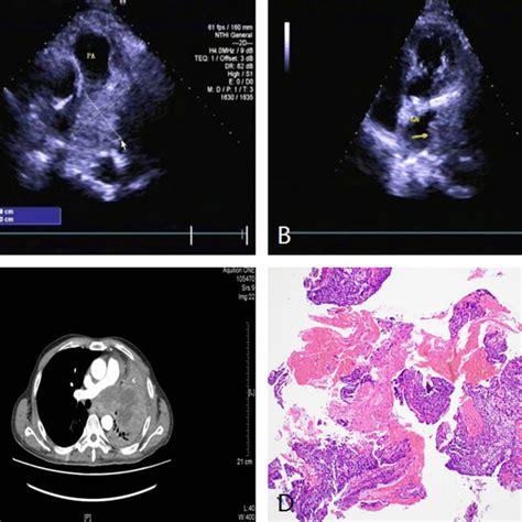Left Hilar Lung Cancer In A 51 Year Old Man A And B Tte Showed An