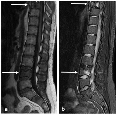 Lesions On Spine
