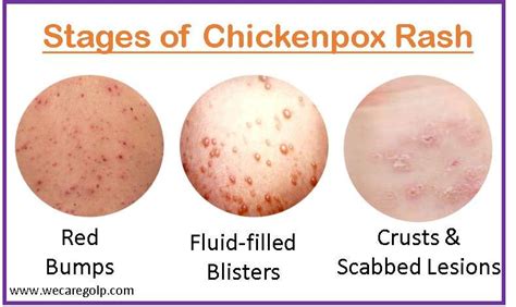 List 97 Pictures Chicken Pox Photos Early Stages Updated