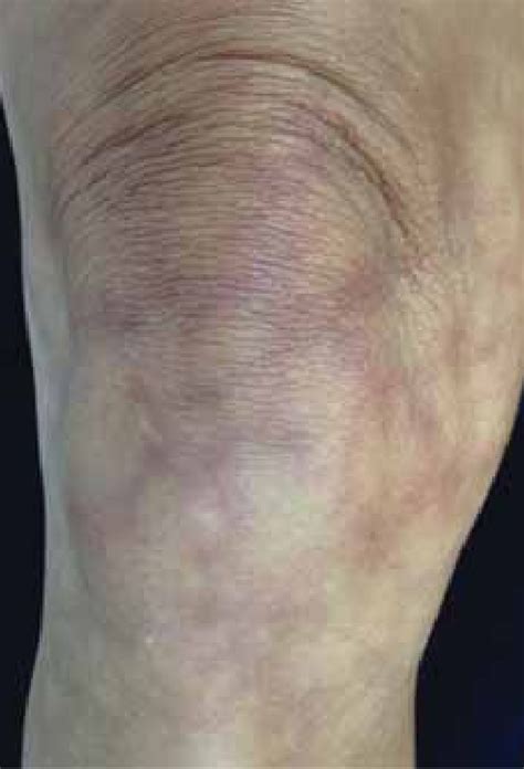 Livedo Reticularis Detail Showing The Lacy Aspect Download