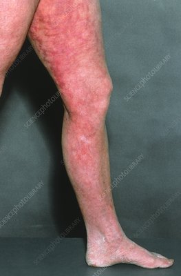 Livedo Reticularis On A Patient S Leg Stock Image M200 0092