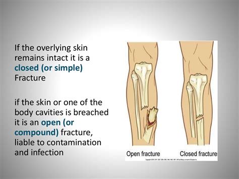 Management Of Closed Fracture