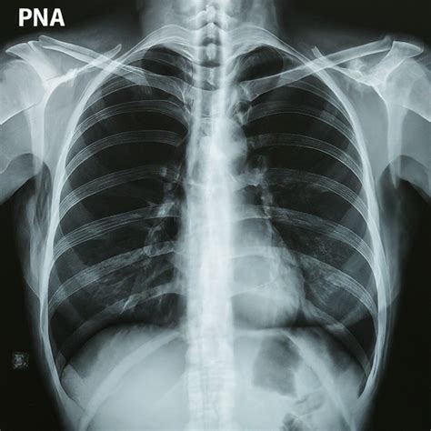 Medical Pna Abbreviation