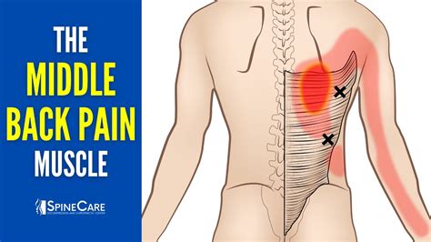 Middle Back Pain Left Side