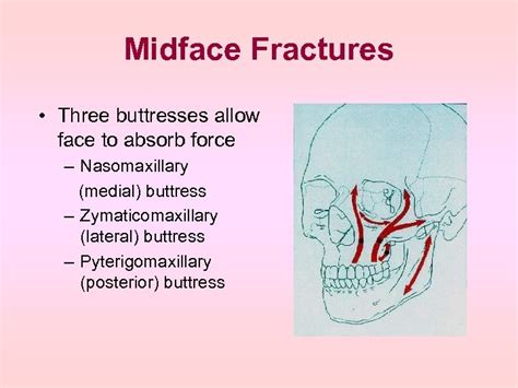 Midface Fractures Evaluation And Management E Razmpa M