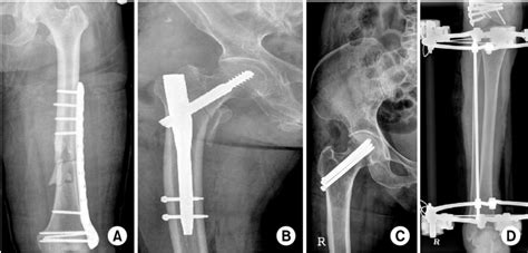 Minimally Invasive Osteosynthesis Techniques For Humerus Fractures