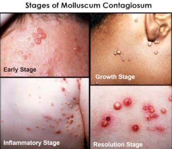 Molluscum Contagiosum Early Stages Otosection