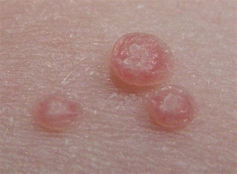Molluscum Contagiosum Find Out More About This Growing Viral Skin Co