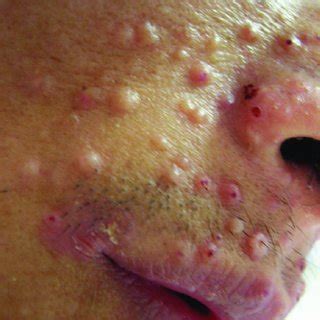 Molluscum Contagiosum Like Skin Lesions Associated With P Marneffei