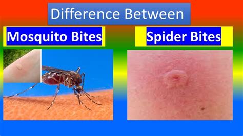 Mosquito Bite Vs Spider Bite