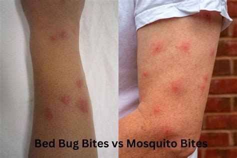 Mosquito Bites Vs Bed Bug Bites