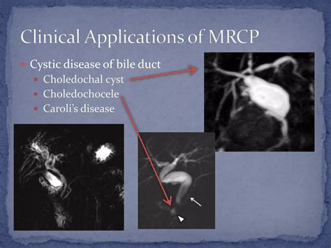 Mrcp Magnetic Resonance Cholangiopancreatography In Scientific