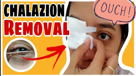 My First Surgery Chalazion Removal Nickz Sc Youtube