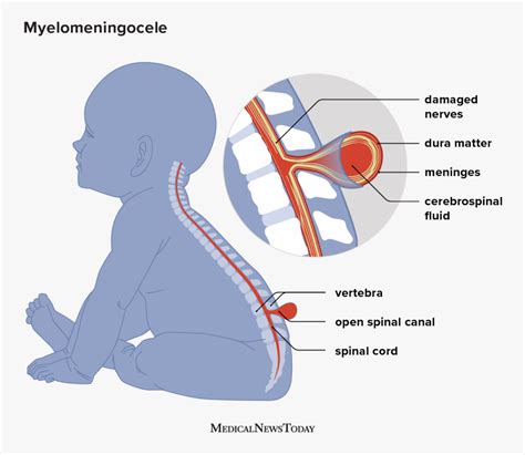 Myelomeningocele Definition Symptoms And Treatment