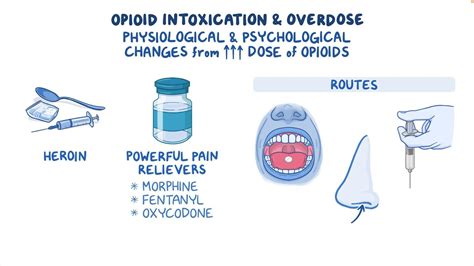 Opioid Intoxication Overdose Clinical Sciences Osmosis Video Library