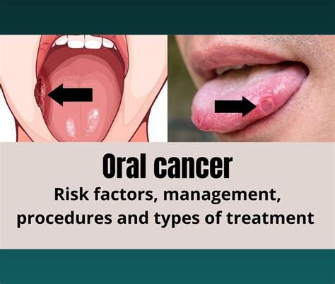 Oral Cancer