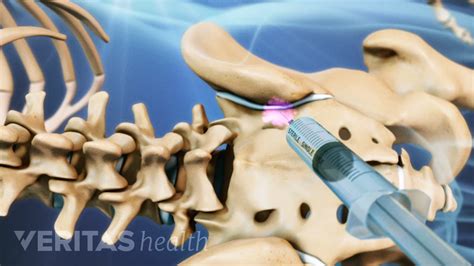 Orthopedic Spine Si Joint Injections For Pain Usa Spine Care