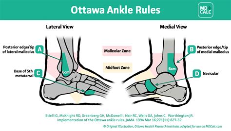 Ottawa Ankle Rules Guide