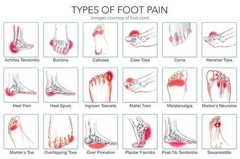 Pain Under The Foot While Walking At Denise Lewellen Blog