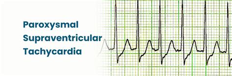 Paroxysmal Supraventricular Tachycardia