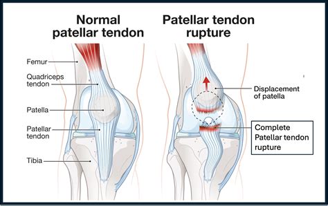 Patellar Tendon Rupture