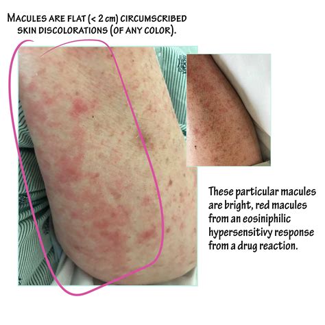 Pathology Glossary Macule Draw It To Know It