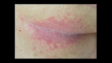 Perianal Streptococcal Dermatitis