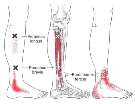 Peroneus Longus Muscle Pain