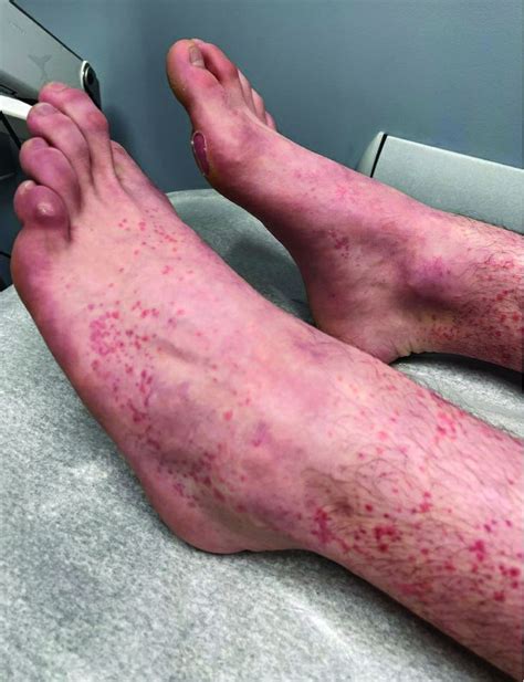 Petechiae Rash On Feet Vrogue Co