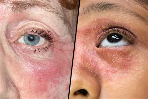 Photos Of Eczema On Face