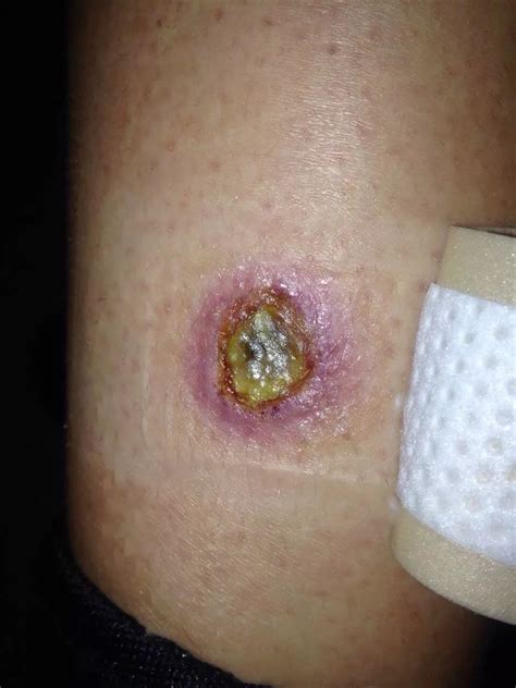 Photos Of Infected Spider Bites